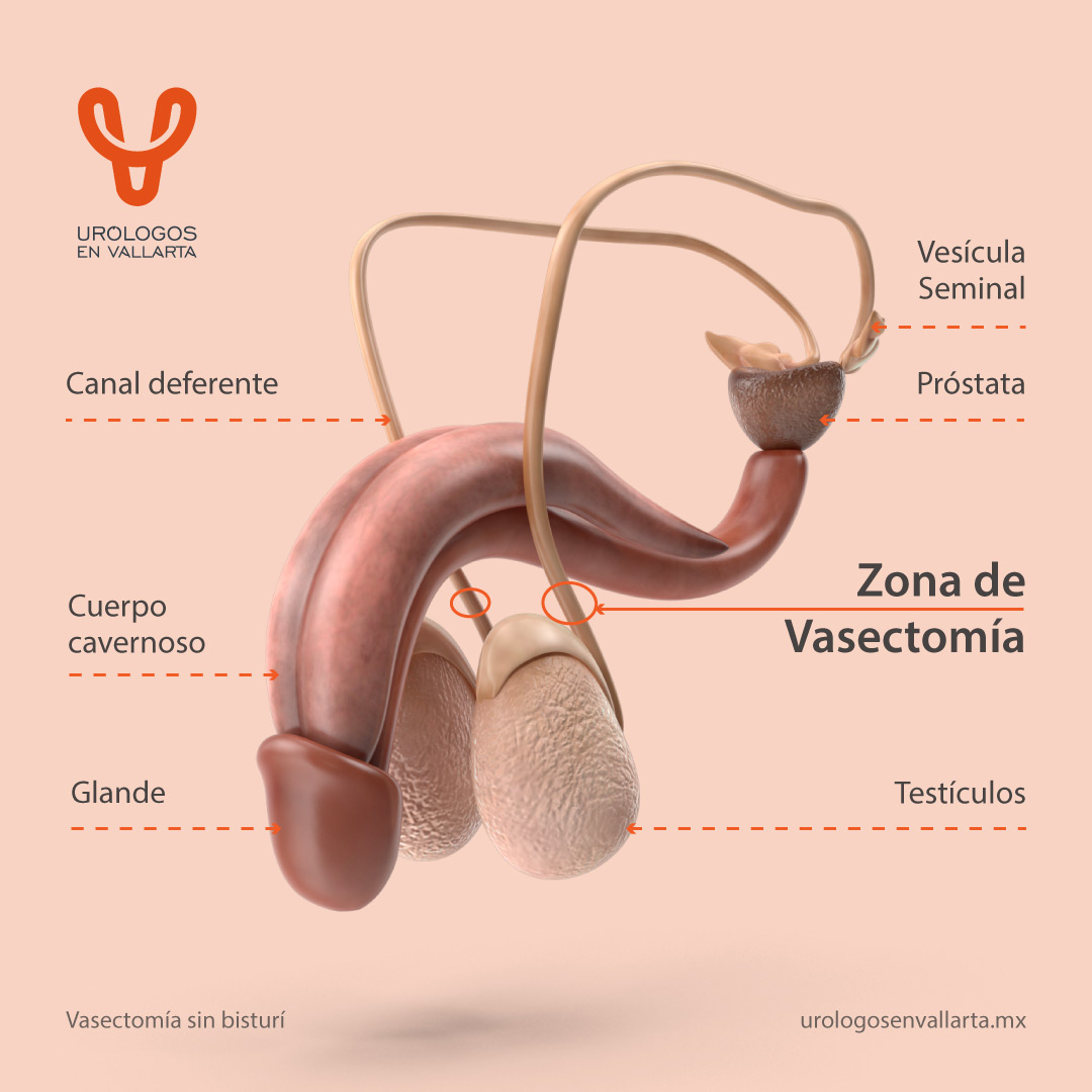 Mitos Y Preguntas Frecuentes Sobre La Vasectom A