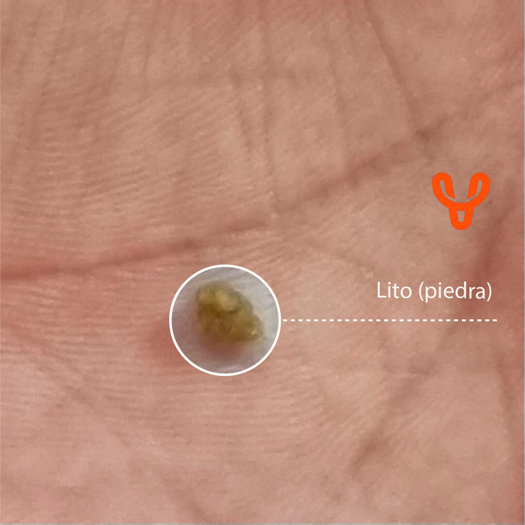 Todo acerca de la litiasis renal o “piedras” en el riñón