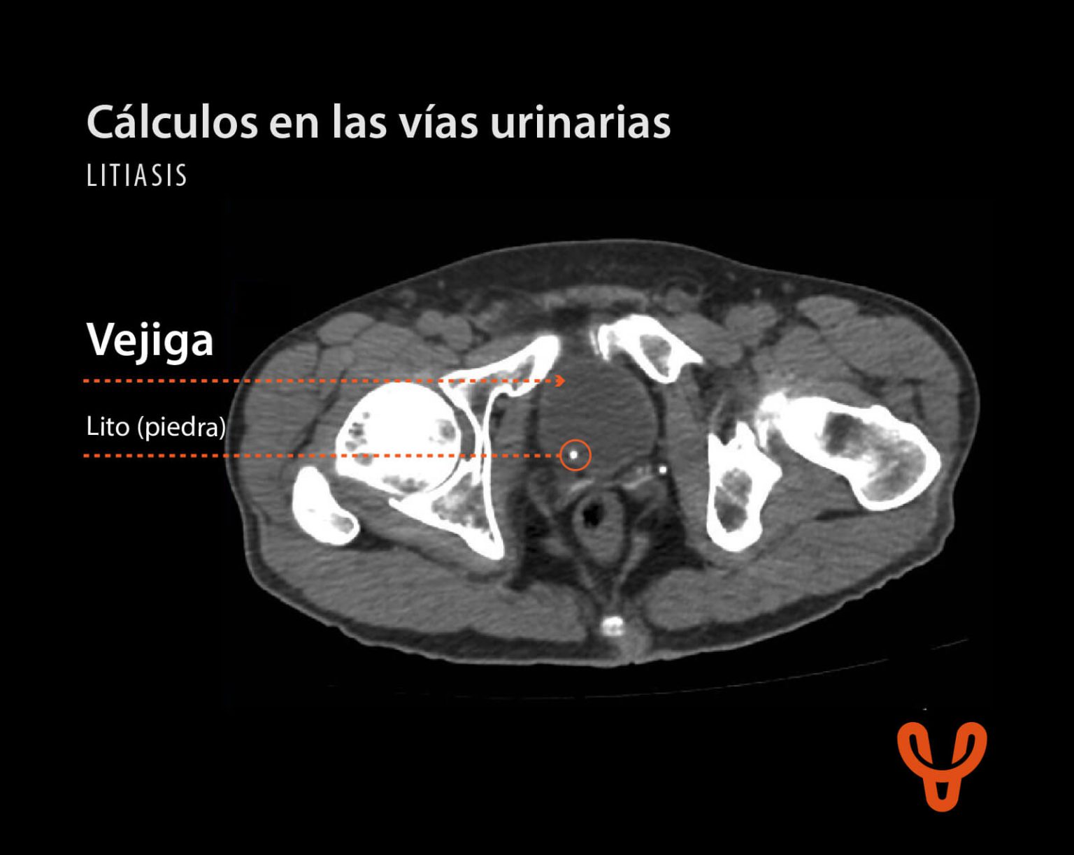 Todo acerca de la litiasis renal o “piedras” en el riñón
