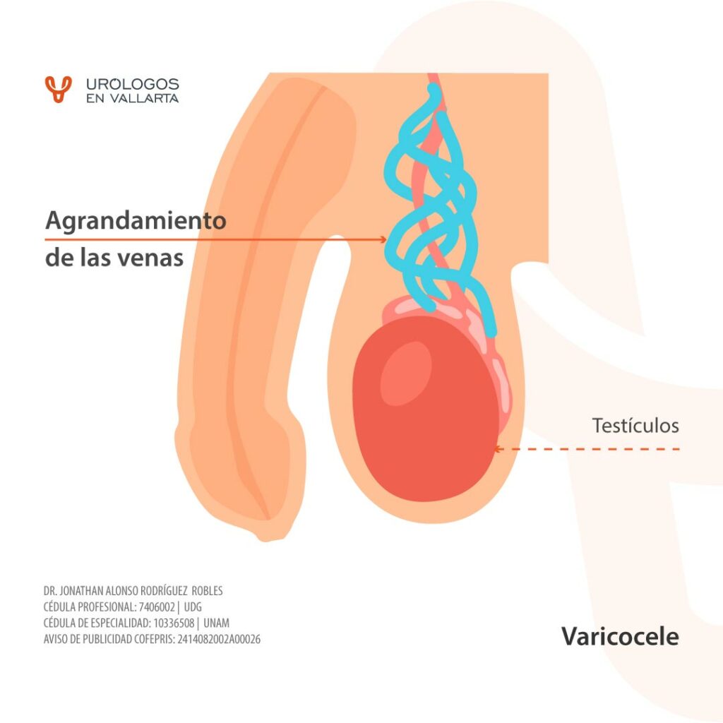 Venas dilatadas en los testículos